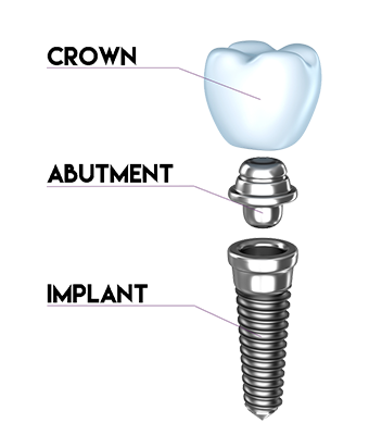 Dental Implant Illustration