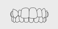Crossbite: Upper and lower jaws don’t line up.