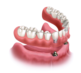 Implant Supported Dentures