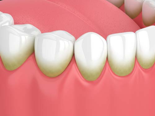 Gum Disease Illustration