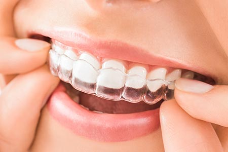 Invisalign clear aligner on teeth